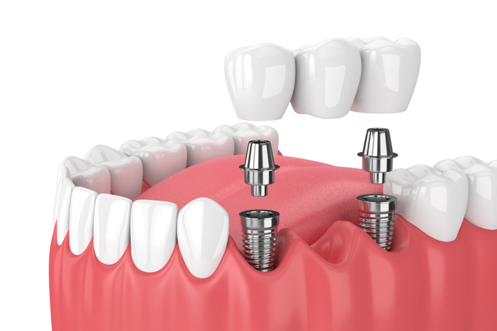 3d render of jaw and implants with dental bridge