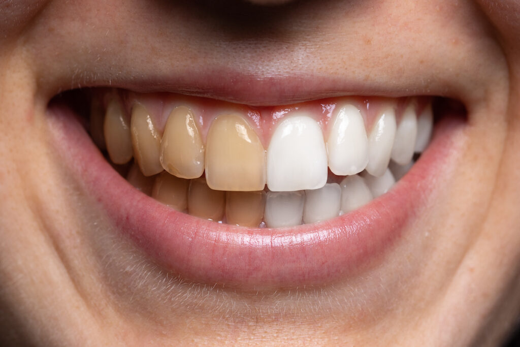 Whitening vs. Removing Surface Stains - Miller Comfort Dental